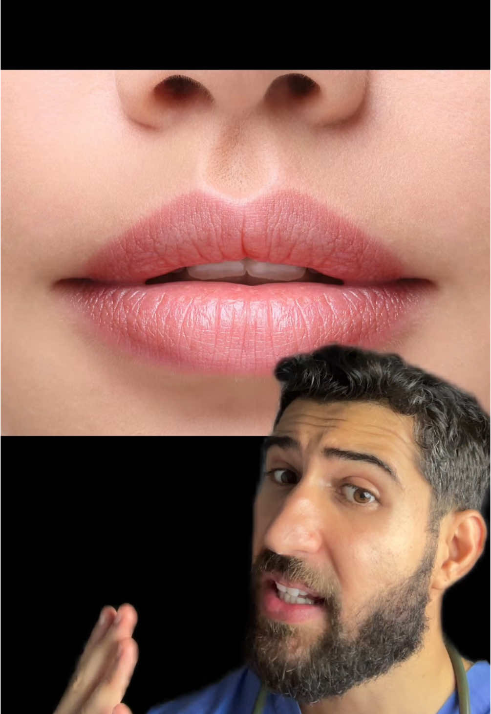 “I Hate My Lips” #wait The Cupid's bow lip is considered one of the rarest and most distinct lip shapes. It is characterized by a pronounced double-curve at the center of the upper lip, resembling the bow of Cupid, the Roman god of love. This unique lip shape has a well-defined 