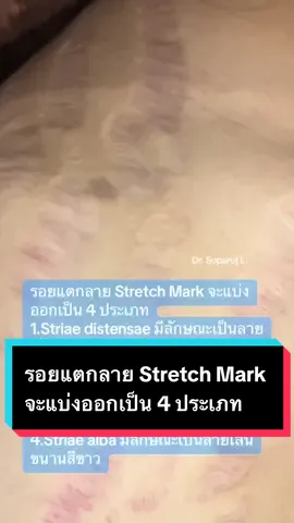 รอยแตกลาย Stretch Mark จะแบ่งออกเป็น 4 ประเภท 1.Striae distensae มีลักษณะเป็นลายเส้นขนานจากการยืด 2.Striae atrophicans มีลักษณะเป็นลายเส้นขนานโดยมีอาการผิวฝ่อ 3.Striae rubra มีลักษณะเป็นลายเส้นขนานสีแดง* 4.Striae alba มีลักษณะเป็นลายเส้นขนานสีขาว  #รักษารอยแตกลาย #ผิวแตกลาย #discoverypicoหมอรุจ #exosomes #Asceexosome #Discoverypicosecondlaser #picosecondlaser  #เลเซอร์รอยแตกลาย  #SylfirmXPlus #exosomes #fractionallaser #รอยแตกลายสีแดง #รอยแตกลายสีขาว #strechtmarks #striae #drsuparuj #demedclinic #RujReview #เรื่องผิว #รีวิวบิวตี้ #tiktokสายความรู้  @Ruj Suparuj  #หมอรุจชวนคุย 