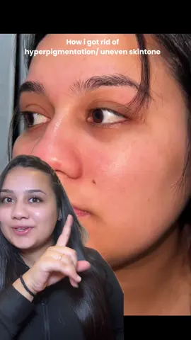 Let me share How i get rid of hyperpigmentation/ dark spots  and got glass skin using @anua_global  #anua #tumericsoap #kojidacidsoap #anuadarkspotserum #darkspots #hyperpigmentation #darkspotserum #txaserum #glassskin