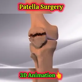patella surgery 👆🏻👆🏻#germany #3danimation #doctorsoftiktok #scienceexperiments #doctorstrange #usa_tiktok #viralvideo #doctorsoftiktok #scienceexperiments #doctorstrange #foryoupage #foryou #viralvideo 
