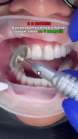 Как отбелить зубы за 5 минут 