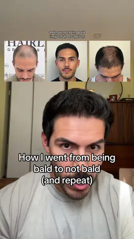 Replying to @kirubel this hair transplant journey has been a JOURNEY for sure #hairtransplant #malepatternbaldness #hairjourney #hairloss #hairtransformation #hairtransplantation #balding #hairloss 