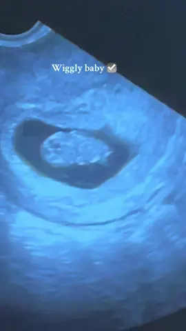 Amazed at how intentional God can be…..I could have just said heartbeat and we would all be thrilled but I added in wiggly baby and I can’t believe we got one. I know they do this at this stage but the ultrasound was so fast. The fact that we saw it is so special 🥹 #ttc #ttccommunity #pregnancy #pregnancyjourney #pregnant #rainbowbaby #rainbowbaby #pregnancyafterloss #fyp #foryou 