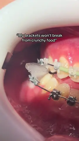 Just a friendly reminder: Crunchy foods can break your brackets! Hold off on ice crunching, chewy lollies, and chocolate until your braces are off at the end of treatment. 😁 #fyp #braces #crunchy #brokenbrackets #orthodontics #ortho #foryou 