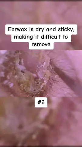Earwax is dry and sticky, making it difficult to remove Part 2 #earwax #ear #earwaxing #fyp #foryou #asmr #earwash #earcleaning #earwaxcleaner #foreignbodyremoval #doctors #earwaxremoval #removing #earcleaningasmr #washing #relaxingvideos #dry 