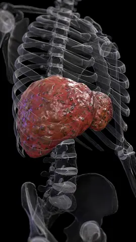 🟡 What Happens in Liver Cirrhosis? 🟡 Healthy liver tissue is replaced by scar tissue over time, leading to impaired liver function. Learn the causes and symptoms. #LiverCirrhosis #LiverHealth #SciePro #EduTikTok #Science #meded #sciart #3d #3dmodel #animation #unity3d #health #education #medstudent #medical