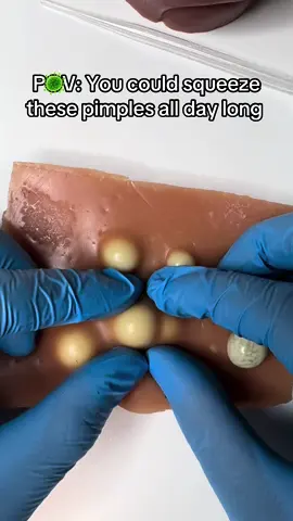 POV: You could squeeze these pimples all day long 🦠🍿🥼👨🏻‍⚕️ #pimplepop #asmrvideo #asmr #pimple #cysts #zit #satisfying #cyst 