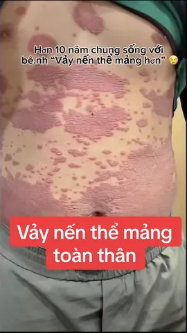 Em bảo “ hơn 10 năm nay em khộ với bê.nh này lắm rồi “ 😥. Thương em#vảynến 