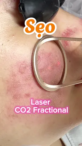 Laser CO2 Fractional  #triseotpvinh #triseonghean  #seoro #seolom #seomun #seothuydau #bacsithanhdalieu #bacsidalieutpvinh 