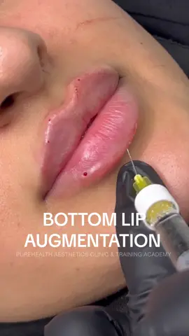 Bottom lip augmentation 👄💉 #russianlipslondon #lipfiller #botoxbeforeafter #russianlips #lipfillerlondon #filler #skinbooster #botoxlondon #fyp #fypppppppppppppp 