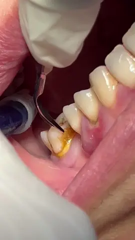 Scaling tartar & calculus #dentist #dental #teeth 