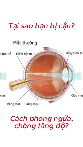 Tại sao bạn bị cận? Cách phòng ngừa thế nào? #canthi #phongngua