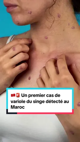 Un premier cas de variole du singe détecté au Maroc 🇲🇦😱 #maroc #marocaine🇲🇦 #tiktokmaroc 