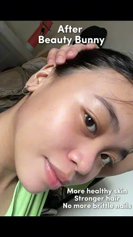 Made a comparison after taking it for a while! Thanks to Beauty Bunny High Potency Multivitamin gummies by @healthfusionph for making me healthier inside and out! 🐰💚 #healthfusionph #beautybunny #healthfusionbeautybunny #fyp #multivitamins #health #beauty #skin #hair #nails 