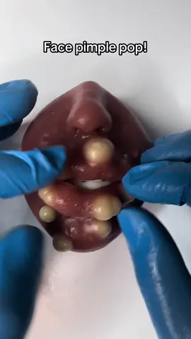 Asmr face pimple pop! #pimplepop #asmrvideo #asmr #pimple #cysts #zit #satisfying #cyst #squeeze 