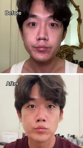Microneedling serum for pore size and datkspots that’s acne safe! @Cosnori US  . . . #acneskin #koreanskincare #kbeauty #darkspottreatment #pores #hyperpigmentation #koreanserum #ampoule 