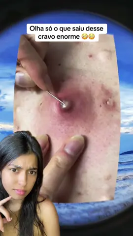 Saiu muita coisa desse cravo! #cravos #limpezadepele #satisfyingvideo #terapia 