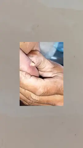 #pimple #Pimple #pimples #pimpleremover #pimplepopper2021 #pimplepopperaddict #pimplepatch #pimpleremoval #pimplepopper2022 #pimples_brufoli #satisfying #Satisfying #satisfyingvideo #satisfyingvideos #satisfyingsounds #satisfyingsound #satisfyingcleans #satisfyingasmr #satisfyingart #satisfyinglips #acne #Acne #acnetreatment #acneskin #acnefighter #acneproneskin #acnescars #acnejourney #acneskincare #acnepatch #Blackhead #blackheads #blackheadsremoval #blackheadsss #blackheadsremover #blackheadsremovalmask #blackheadsextractions #blackheadspopping #blackheadstrip #blackheadsout #blackheadsremove #foryou 