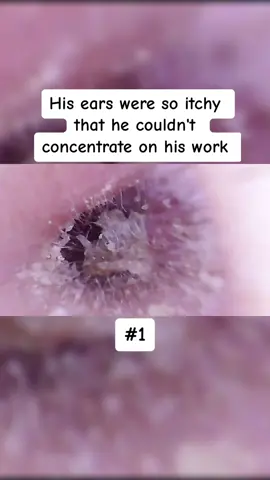 His ears were so itchy that he couldn't concentrate on his work Part 1                     #earwax #ear #earwaxing #fyp #foryou #asmr #earwash #earcleaning #earwaxcleaner #foreignbodyremoval #doctors #earwaxremoval #removing #earcleaningasmr #washing #relaxingvideos #dry 