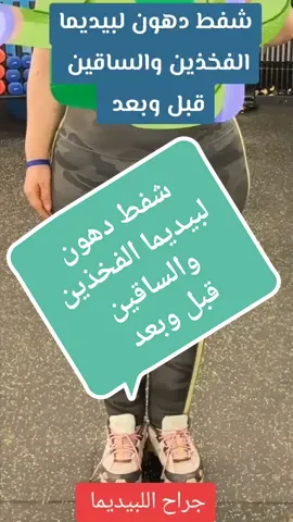 #CapCut شفط دهون لبيديما الفخذين والساقين قبل وبعد  #lipedemafighter #وذمة_شحمية #ليبيديما #lipedemaawarenes #lipedemabrasil #lipedemagirl #lipedemasurgery #lipedema #وذمة 