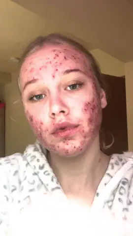 🥲#izotekkuracja #acne #fyp #acneisokay #tfypシ🔥 
