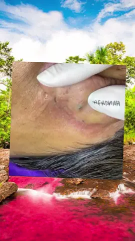 #squeeze #squeezeyuk #pimple #pimplepop #acne #skincare #blackhead #foryourpage