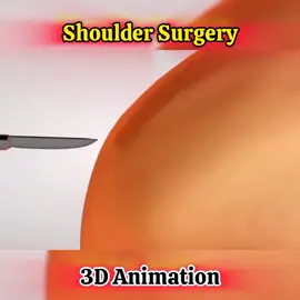 shoulder surgery👆👆👆 #unitedkingdom #unitedkingdom #3danimation #scienceexperiments #doctorstrange #doctorsoftiktok #newtechnology #newtrend #surgerytiktok #Science #positivevibes #germany #foryourpage #foryou #viraltiktok #foryou #viraltiktok 
