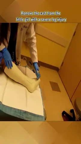 After Months Of Being Injured, The Girl’s Cast Was Removed By The Doctor #cast #newcast #fypage #emotional #doctorstrange #firsttime #castvideo #removal #cutting #castremoval #legcast 