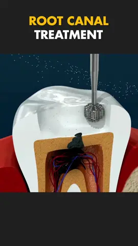 Root Canal Treatment 🦷 #rootcanal #rootcanaltreatment #rootcanalprocess #rootcanalsurgery #rootcanalfilling #rootcanalsurgery #medical3danimation #3dmedicalanimation #teethsurgery #toothsurgery 