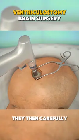 Ventriculostomy brain surgery #3dmedical #3dmedicalanimation #venti #ventriculostomy #ventriculomegalyawareness #ventriculostomydrain #ventriculostomia #ventriculostomy