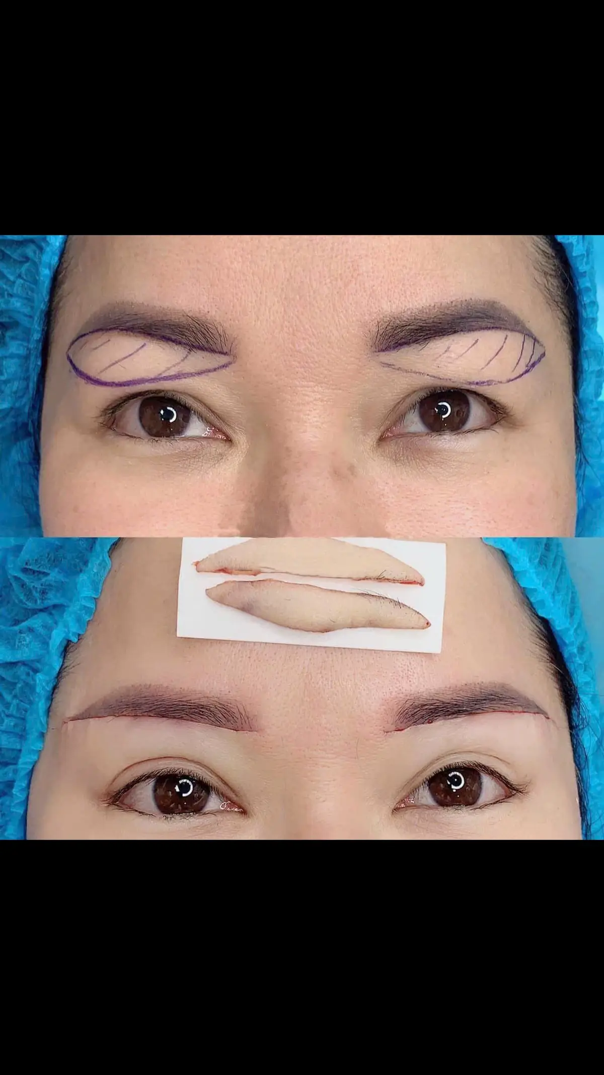 TREO CUNG CHÂN MÀY ✨ 👉 ĐƯỜNG MAY SIÊU MỊN VÀ MƯỚT RƯỢT   👉 ĐÍNH VÀ NÂNG CƠ 3 LỚP   👉 TRÁNH TỈ LỆ DÃN SẸO 100%   👉  CHỈ TỪ 1999K   ----------------------- #camau #thammycamau #phauthuatthammy 🏣 HỆ THỐNG THẨM MỸ VIỆN QUỐC TẾ VISA - CÀ MAU 📌 CHI NHÁNH CÀ MAU: 295- LÝ THƯỜNG KIỆT- PHƯỜNG 6- CÀ MAU ☎️ HOTLINE: 0353.169.716