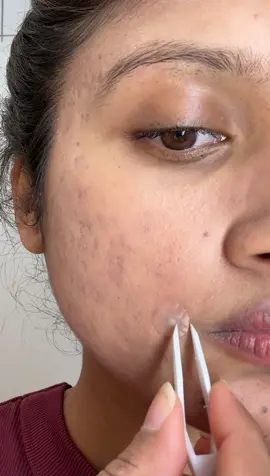 Pimple patch peel off✌️ #pimplepatch #pimpleremover #pimplepatches #acnepatch #pimplepop #acneskin #acneproneskin 