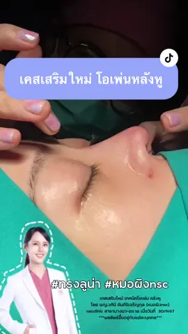 เสริมดั้งครั้งแรก ยื่นเรฟจมูกแบบ #นางเกาหลี #ลูกสาวหมอผิงnsc 👩🏻‍⚕️ #ทรงลูน่า เคสคนไข้เป็นเคสเสริมใหม่ ปัญหาเดิมคือ รู้สึกว่าหน้าตรงหน้าไม่มีมิติ ไม่มีสันจมูก ฐานจมูกกว้าง ปีกจมูกบาน เลือกทำเทคนิคโอเพ่นหลังหู กับ #หมอผิงnsc @หมอผิง Facial plastic surgeon 