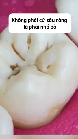 Sâu răng độ 1 (Mức độ nhẹ): Răng bắt đầu xuất hiện các đốm đen, nâu. Sâu răng độ 2 (Sâu răng đã ăn vào tuỷ): Vi khuẩn dần tấn công vào ngà và tủy răng khiến người bệnh cảm thấy đau khi ăn uống. Sâu răng độ 3 (Sâu đến tủy răng): Vi khuẩn đã ăn sâu vào chân răng và có thể gây biến chứng xấu. #nhakhoa #nhakhoavananh #saurang #hoimieng #xuhuong #fyp 