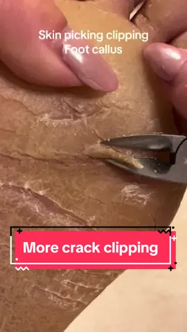 Final callus crack clipping for now ✨ #callusremoval #parmeseanpalms #callustreatment #skinpeeling #skinpicking #podiatrylife 