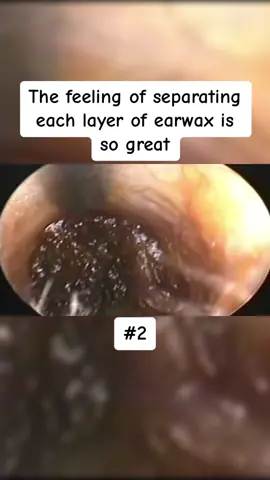 The feeling of separating each layer of earwax is so great Part 2 #earwax #ear #earwaxing #fyp #foryou #asmr #earwash #earcleaning #earwaxcleaner #foreignbodyremoval #doctors #earwaxremoval #removing #earcleaningasmr #washing #relaxingvideos #dry 