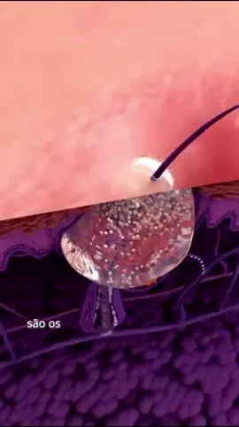 Você já se perguntou por que a acne/espinha aparece? A acne não é apenas uma “pele oleosa”. Ela é bem mais complexa e envolve 4 pilares fundamentais: Inflamação + Excesso de sebo + Obstrução do folículo + Proliferação de bactérias.  💡 E ainda tem mais! A acne pode ser agravada por vários fatores, como hormônios, estresse, dieta rica em carboidratos, consumo de laticínios, poluição, uso de cosméticos, certos medicamentos, falta de sono e até o fumo! Você já sabia desses outros fatores? Conta aqui nos comentários o que mais te surpreendeu! 👇 - Larissa Oenning | CRM 242162 Médica Residente de Dermatologia EPM-UNIFESP