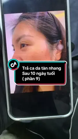 Trả ca da tàn nhang  Sau 10 ngày tuổi