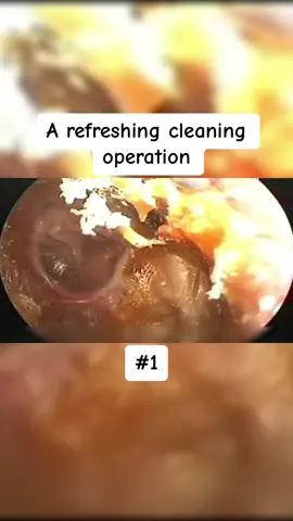 A refreshing cleaning operation Part 1 #earwax #ear #earwaxing #fyp #foryou #asmr #earwash #earcleaning #earwaxcleaner #foreignbodyremoval #doctors #earwaxremoval #removing #earcleaningasmr #washing #relaxingvideos #dry 