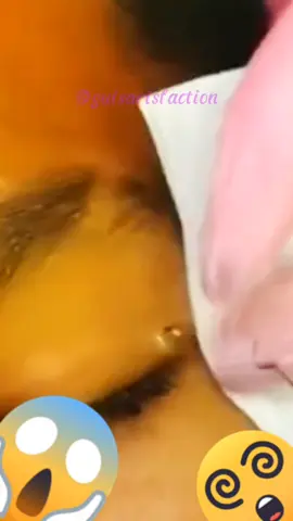 💥🤩 Dr. Sarisfaction 🤩💥 Watch Me Pop The Biggest Blackheads and Pimples Ever 🎥 🚀✨ You Won’t Believe The Results 😱 Like, Comment and Share If You Enjoyed This Video 💖 Follow Me For More Amazing Extractions 🔥  #skincare #beauty  #pimplepopping #blackheadremoval #whiteheadremoval #zits #acne #skin #SelfCare #satisfying #asmr #pimple #pimples #acneremoval #cyst #blackhead #whitehead #blemish #zit #rosacea #eczema #psoriasis #skincareroutine #skincaretips #skincareaddict #selfcare #satisfying #asmr #asmrsounds #cravosantigos #espinhas #cravos #brufoli #cravoslovers #cravosencravados #espinhasnacara #espinhasinternas #cuidadoscomapele #skincare #limpezadepele #extracaodecravoseespinhas #espinhasgigantes #cravosgigantes #toenail #tirandocravos #remocaodecravos #tirandocravos #ความงาม #ลดสิวหน้าใส #คลีนซิ่ง #ช่างเสริมสวย #racunskincare #skincareviral #uforaskincare #kulitcantik #peleoleosa #pimples #cleangirl #skincareroutine #rinoplastia #estetica #dryskin #viralnails #nailsartvideos #limpiezafacial #facial #nailtech #esteticafacial #espinillas #onglesengel_ #pelle #nailsoftiktok #soddisfacente