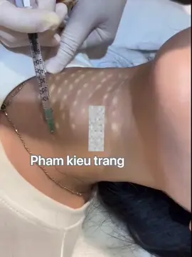 Botox xoá nhăn vùng cổ, siêu hiệu quả giảm nhăn làm trắg căng nữa ạ #phnomphenh #shihanukville #xuhuong #xuhuongtiktok #hot 