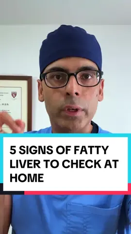 Harvard Alum Doctor : 5 Signs of Fatty Liver You Can Check at Home ‼️🚨 #fattyliver #medical 