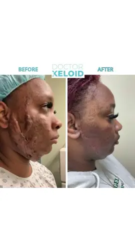 Our lovely patient came to #DrKeloid for the change of a lifetime. She developed #keloids as a result of wearing facial masks during the pandemic of COVID-19. Over time her keloids grew so large and painful that they were impacting her quality of life. Today, we are proud to share our results as a mark of hope to restore her natural confidence and raise awareness for those who may be suffering from painful, itchy keloids. Time to let go of your worries and give Dr. Keloid a call 📲 888-979-3528!  #keloids #keloidremoval #tb #beforeandafter #srt #skindoctor #plasticsurgeon #facemask #nyc