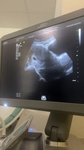 Hallo Würmchen #8ssw#icsi#ivf#schwanger#pregnant #kiwu#ultraschall#baby 