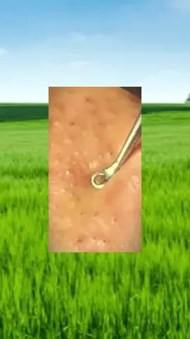 #squeezeyuk #satysfying #pimple #foryou #relax
