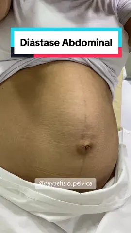 #gestante #maternidade #diastaseabdominal #gestacao #gravidez #maedeprimeiraviagem #posparto 