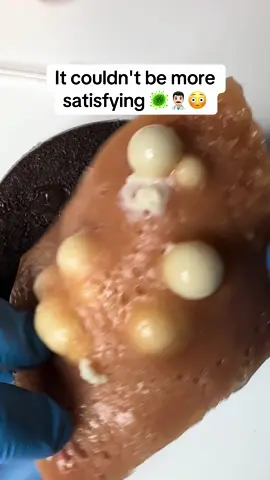 It couldn't be more satisfying: Asmr mochi pimple pop👨🏻‍⚕️🫠 #asmrsounds #mochi #asmr #fyp #pimple #zit #satisfying #medical #medicalstudent #pimplepop #relax #skincare 