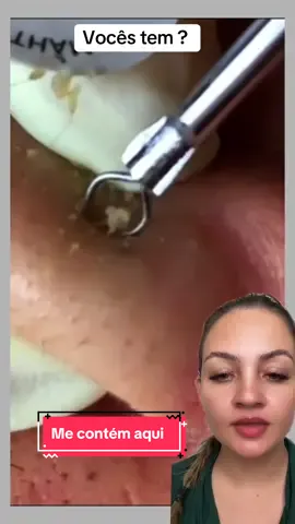 Eu particularmente tenho muitos #satisfatório #terapia #limpezasatisfatoria #cravos #reagindo 