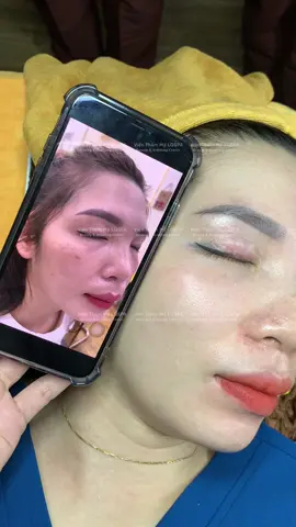 Nám đinh #chamsocdamun#chamsocdaseo#chamsocdanam#tanbinh#govap #Lequynh #quynhle #lqspa #hocnghespa  #chamsocda #lequynhspa #vienthammylqspa#lqspabeautyacdemy