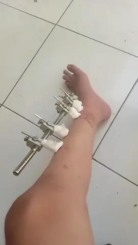 bismillahirrahmanirrahim semoga bln depan lancar untuk lepas pen doai yah, heheh kali ada dari kali ada yg ngasih obat kalsium tulang🤣🤣🤣 #frakturtibiafibula #operasilepaspen #operasi 
